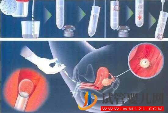 人工授精和試管嬰兒詳細介紹及對比？(圖1)