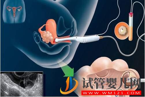 和田人工授精和試管嬰兒的區別及手術費用是多少？(圖2)