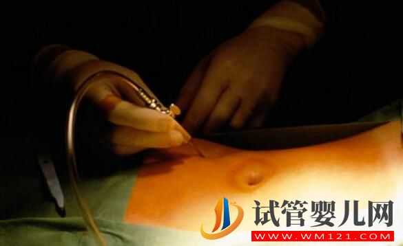 做試管嬰兒取多少個卵子合適？(圖3)