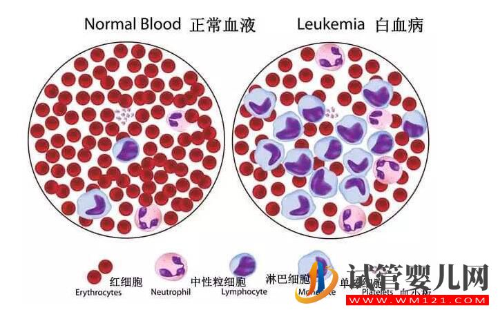 做試管嬰兒真的容易得白血病嗎？(圖1)