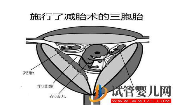 試管嬰兒減胎術在哪些情況下使用 要注意哪些(圖2)