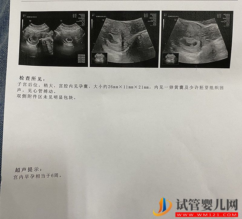 兩次試管都生的是女兒第三次我想要個兒子(圖1) 兩次試管都生的是女兒第三次我想要個兒子(圖1)