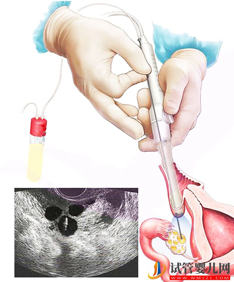 取卵圖 第一次做試管嬰兒你需要了解這22個常見問題(圖2)