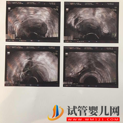 用別人的卵子做試管生孩子要多少錢?(圖1)