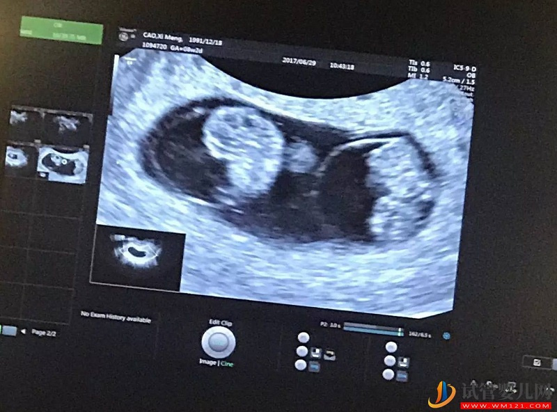 雙胞胎與單胎癥狀大有不同，孕媽教你看懂這5個暗示(圖2)