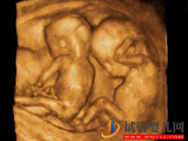 妊娠期血糖偏高會不會造成雙胎一起胎停？(圖1)