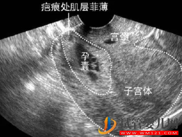 二胎38周剖腹產后遺癥太多！產后每天都在后悔(圖2)