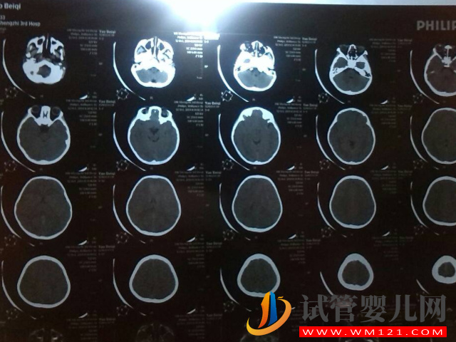 寶寶摔了千萬不要做腦部ct的原因匯總，過來人都直呼后悔！(圖1)