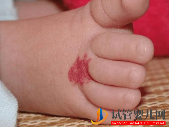 兒童不同位置胎記圖解大全，是福是禍點看看了才知道(圖1)