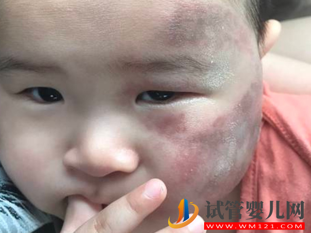 兒童不同位置胎記圖解大全，是福是禍點看看了才知道(圖2)