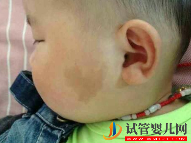 兒童不同位置胎記圖解大全，是福是禍點看看了才知道(圖3)