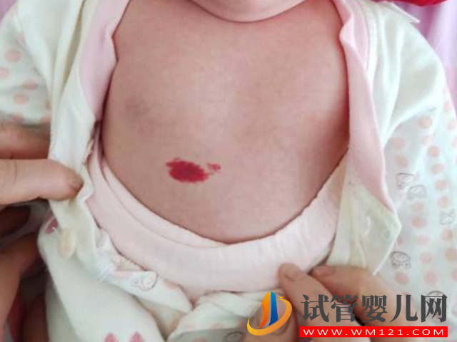 兒童不同位置胎記圖解大全，是福是禍點看看了才知道(圖5)
