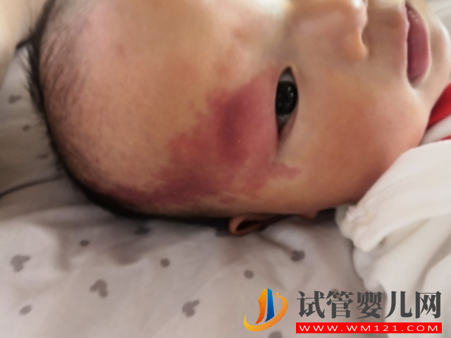 兒童不同位置胎記圖解大全，是福是禍點看看了才知道(圖6)