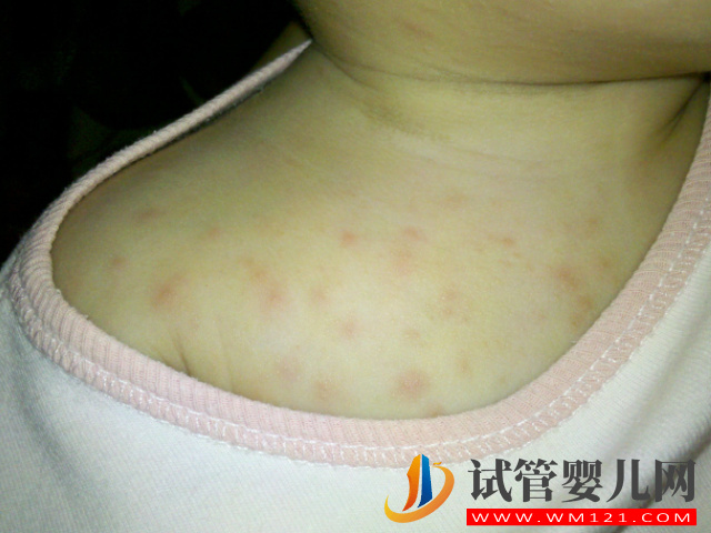 5種常見典型濕疹類型圖片分享，不同類型“防與治”都不一樣(圖4)