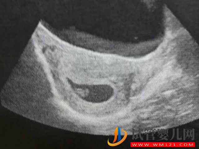 b超監測有卵黃囊基本是宮內妊娠，不管出現早晚都穩了(圖3)
