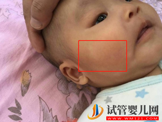 新生兒白色胎記圖片大全，發病幾率小但危害大(圖2)