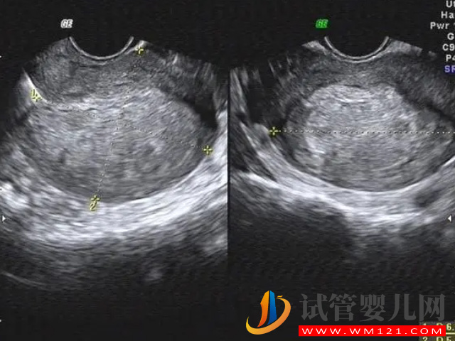 子宮內(nèi)膜薄做試管攻略分享，選對適合試管技術(shù)為首要條件(圖3)