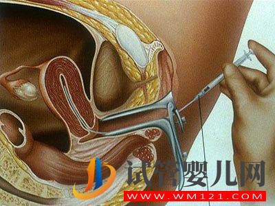 人流后發(fā)生不孕不育可以做試管嬰兒嗎?(圖1)