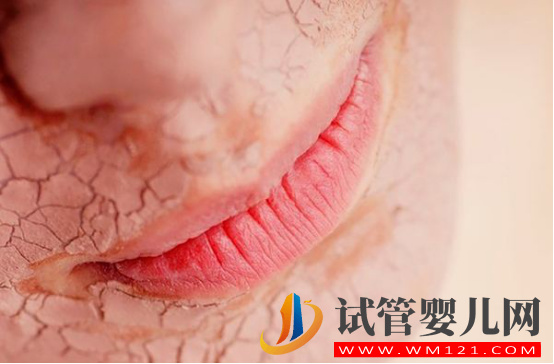 瀘州孕期皮膚干燥應該怎么辦？(圖1)