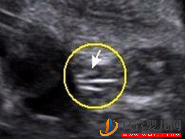 16周最明顯的女寶b超圖分享，看這三條線一眼便知！(圖2)