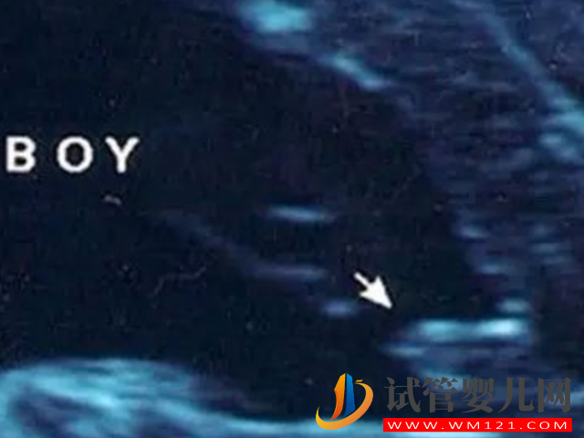 16周最明顯的女寶b超圖分享，看這三條線一眼便知！(圖3)