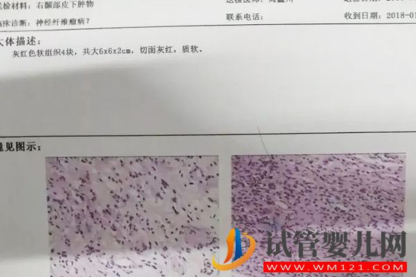 3代試管篩查神經纖維瘤方法詳解：三個步驟可提高準確率(圖3)