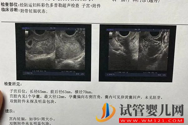 自貢檢查卵泡做b超還是陰超視情況而定，但這3點區別要知曉(圖3)