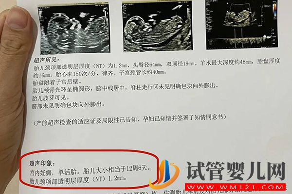 nt值是否一樣不是判斷龍鳳胎標準，這些看雙胎方法可了解(圖2)