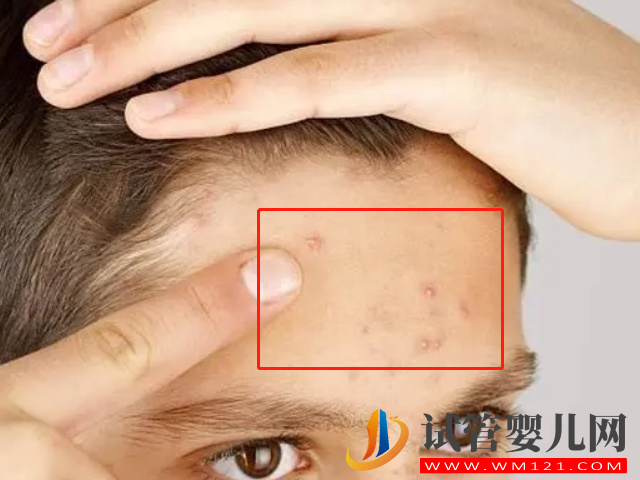 女性多囊長痘和普通長痘有區別，外在表現和癥狀都不一樣(圖1)