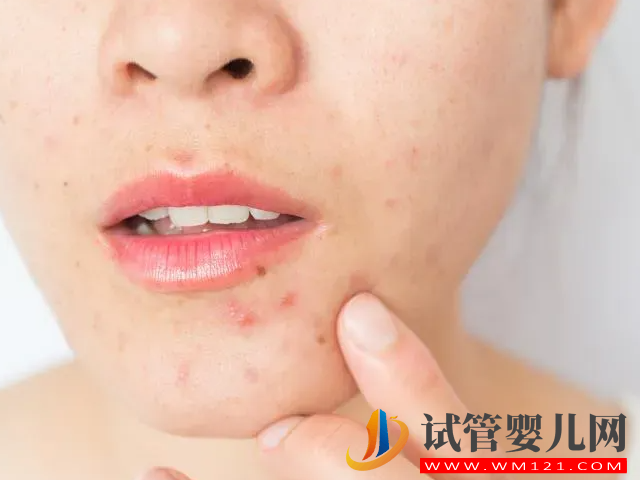 女性多囊長痘和普通長痘有區別，外在表現和癥狀都不一樣(圖3)