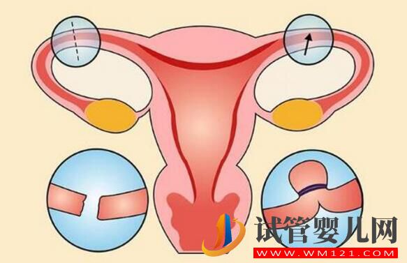 銅仁女人結扎了可以做試管嬰兒嗎？來看看吧(圖1)