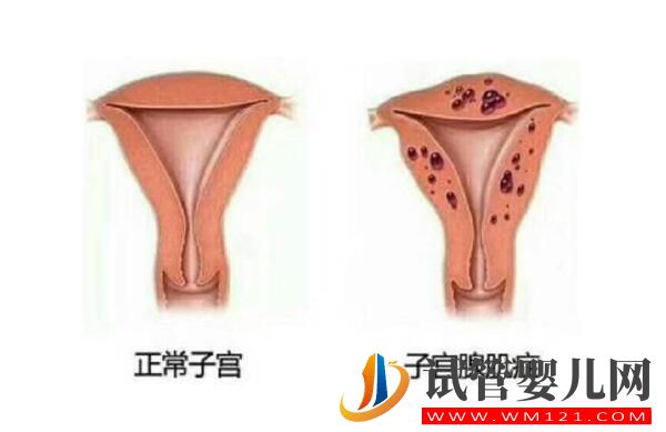 子宮腺肌癥能做試管嬰兒嗎？應該如何備孕(圖1)