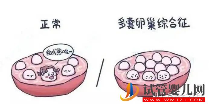 多囊卵巢和多囊卵巢綜合征的區別是什么(圖1)