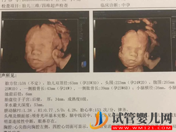 孕期做四維彩超讓寶寶露臉的好方法有4種，找到技巧很關鍵！(圖1)