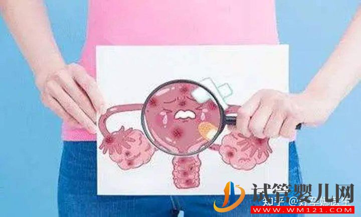 子宮內膜異位到底是什么,有哪些癥狀_又該如何預防(圖3)
