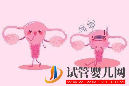 子宮內膜異位到底是什么,有哪些癥狀_又該如何預防(圖2)