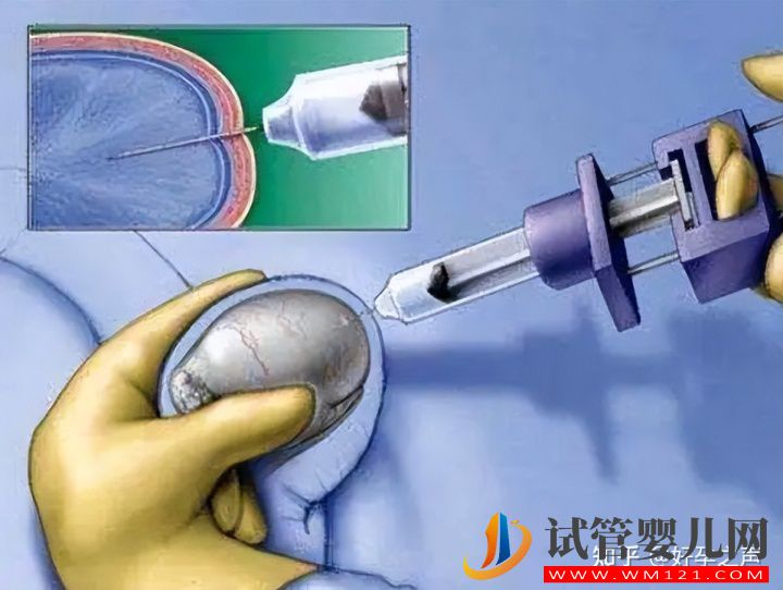 無精子癥的生育之路(圖3)