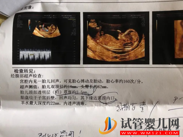 孕13周NT男孩女孩區別圖，內附已生寶媽們nt值作參考(圖1)