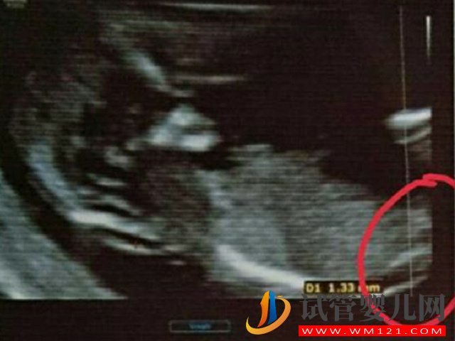 孕13周NT男孩女孩區別圖，內附已生寶媽們nt值作參考(圖3)