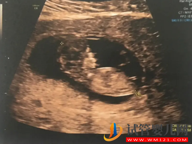 孕13周NT男孩女孩區別圖，內附已生寶媽們nt值作參考(圖4)