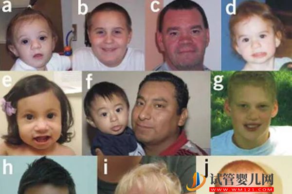 染色體1q21·1片段重復綜合征詳解，該病超五成遺傳自母親(圖2)