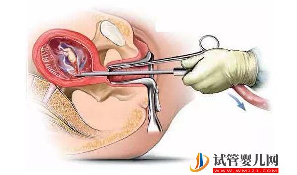 成都如何擁有好的內(nèi)膜? 成都如何擁有好的內(nèi)膜?(圖1)