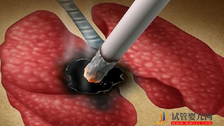 肺癌患者可以過性生活嗎？你知道為什么肺癌不傳染嗎？(圖2)