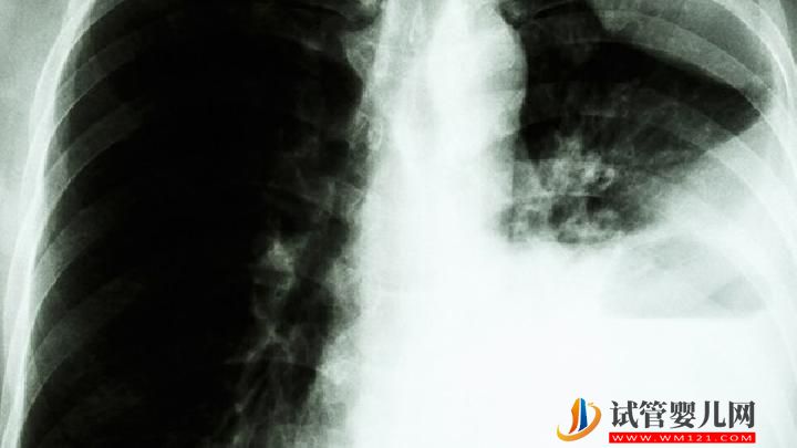 肺癌患者可以過性生活嗎？你知道為什么肺癌不傳染嗎？(圖1)