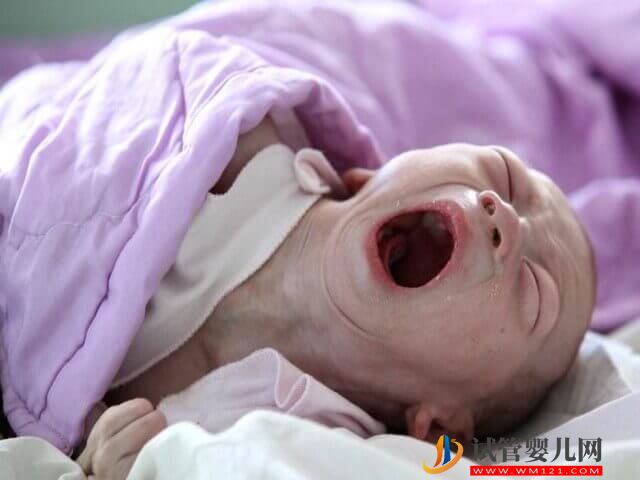 19號染色體片段缺失的小孩行為會有哪些表現？(圖1)