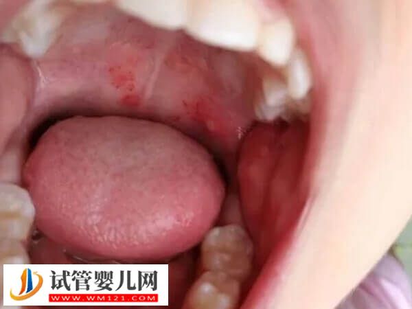 移植后得了口腔潰瘍的原因是什么(圖1) 移植后得了口腔潰瘍的原因是什么(圖1)