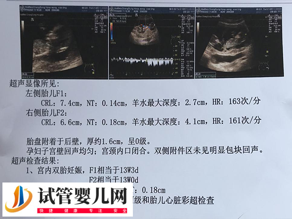 日本試管嬰兒雙胞胎幾率有多大(圖1) 日本試管嬰兒雙胞胎幾率有多大(圖1)